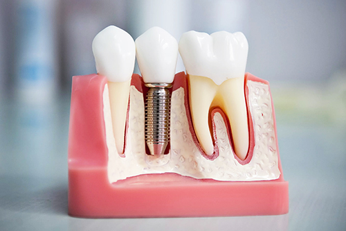 В чем выгода имплантации зубов