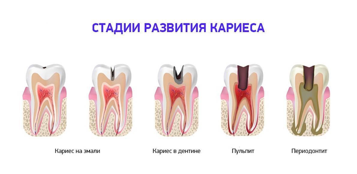 Наложение мышьяковистой и параформальдегидной пасты в Саратове