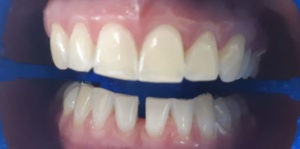 Зубы после отбеливания Zoom 4