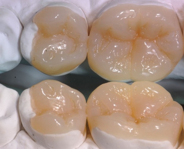 Керамические вкладки в зуб