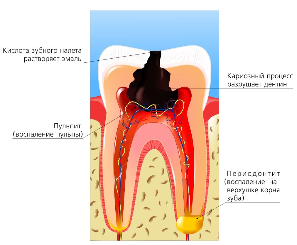 Лечение воспаления периодонтита. Классификация кариес пульпит периодонтит.